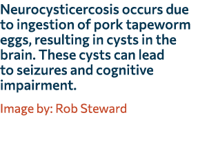 Neurocysticercosis occurs due to ingestion of pork tapeworm eggs, resulting in cysts in the brain. These cysts can le...